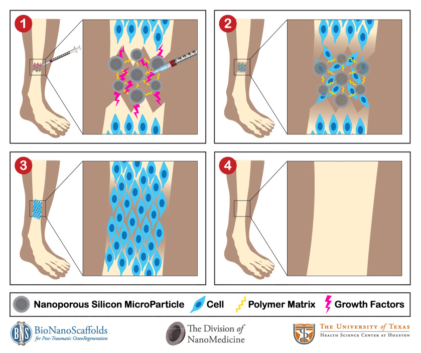 Bone healing. Этапы заживления перелома кости.