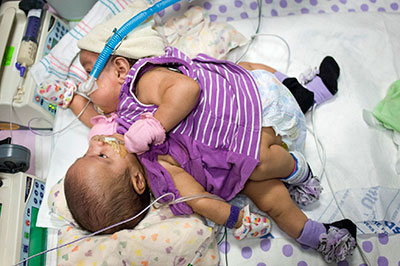 conjoined-twins-5-babies.jpg