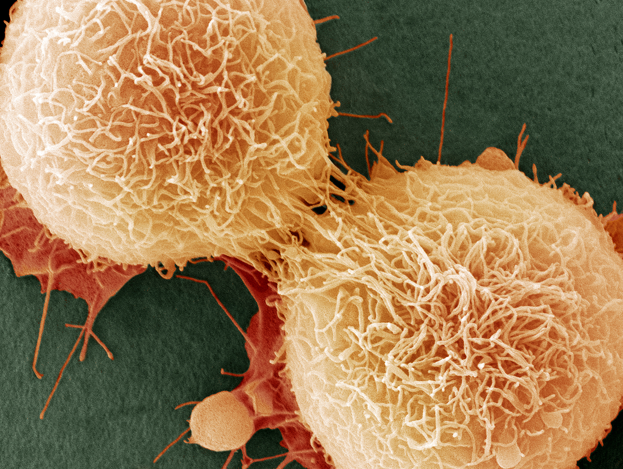 Что такое онкология. Онкологические заболевания. Онкология раковые клетки. Раковая бактерия.