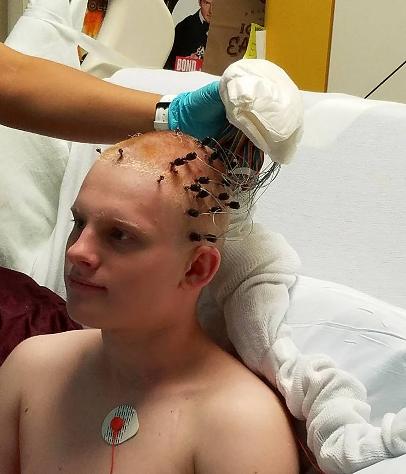 In the summer of 2017 Trysten Pearson, 16 years-old, underwent a surgical procedure at Houston's Children's Memorial Hermann Hospital that entailed placing intracranial electrodes in his brain to localize his seizure focus area.