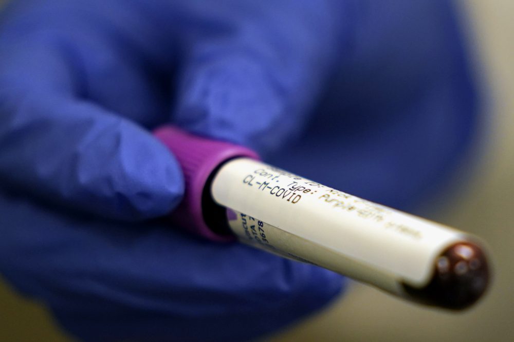 A lab assistant holds a blood sample to be tested for COVID-19 antibodies at Principle Health Systems and SynerGene Laboratory, in Houston. The Houston Health Department is now rolling out its own antibody testing survey, in conjunction with the Centers for Disease Control and Prevention, Rice University and Baylor College of Medicine.
