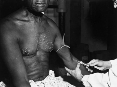 A participant in the Tuskegee Study in the 1930s. A lingering mistrust of the medical system among many Black people is rooted in the infamous study.