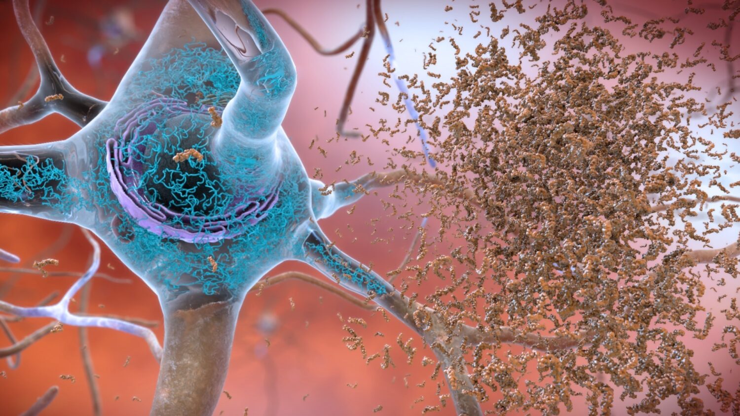 An Alzheimer's drug is on the way, but getting it may still be tough. Here's why – Houston Public Media - Vimarsana News